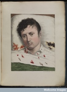 Man with yellow fever Image from Wellcome Library 